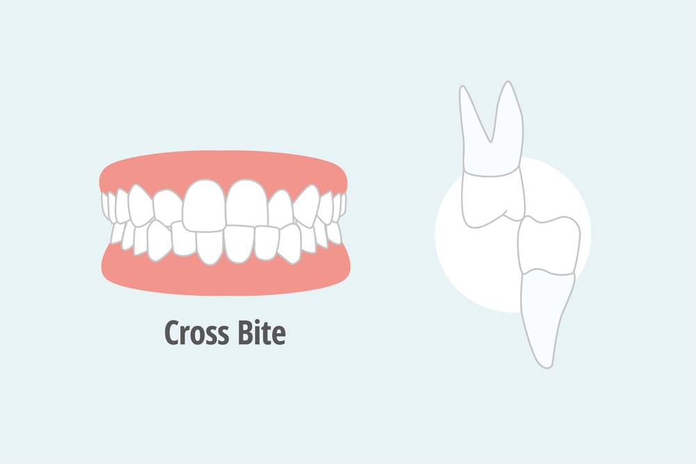 Understanding Cross Bite: Causes, Symptoms, and Treatment Options